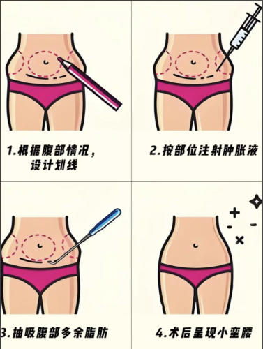 肚子抽脂和脸部拉皮可以一起做么？真人案例+权威数据告诉你答案