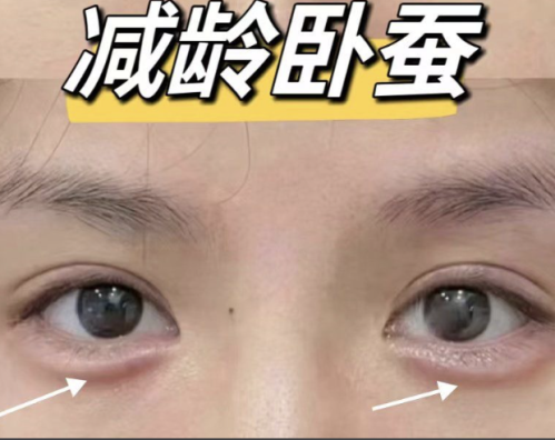 填卧蚕会显老吗？90%求美者踩的坑，看完这篇不翻车