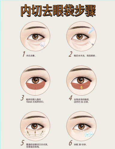 内路切眼袋的效果好吗？三甲医生亲测：闭眼冲的 “无痕焕龄术”