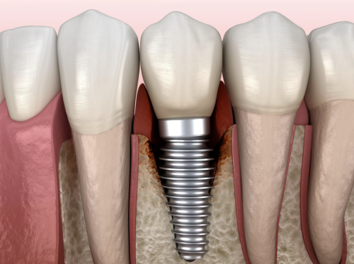 南方医院种植牙贵不贵？最新价格+真实案例，一文算清性价比