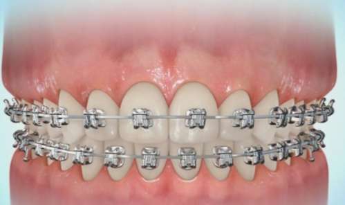 牙齿矫正 牙齿矫正