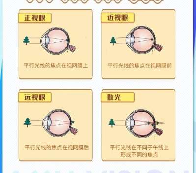 近视眼矫正 近视眼矫正