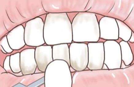 牙齿贴面 牙齿贴面