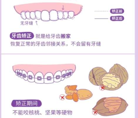 牙齿矫正 牙齿矫正