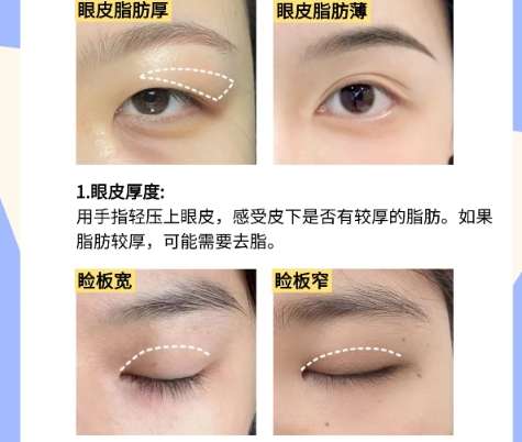 双眼皮 双眼皮