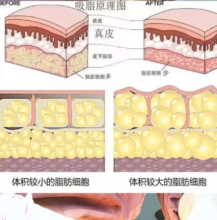吸脂 吸脂