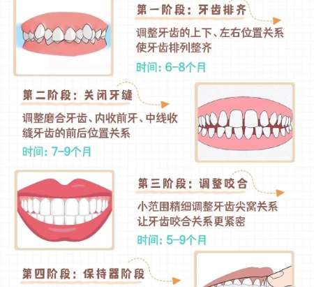 牙齿矫正 牙齿矫正