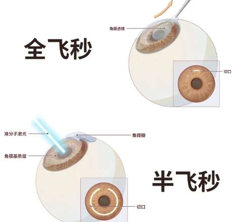 近视眼矫正 近视眼矫正