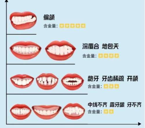牙齿矫正 牙齿矫正