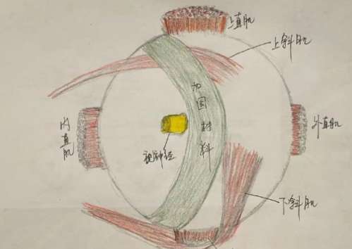 巩膜加固术 巩膜加固术