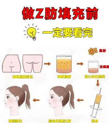 脂肪填充 脂肪填充