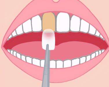 牙齿贴面 牙齿贴面