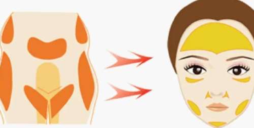 脂肪填充 脂肪填充