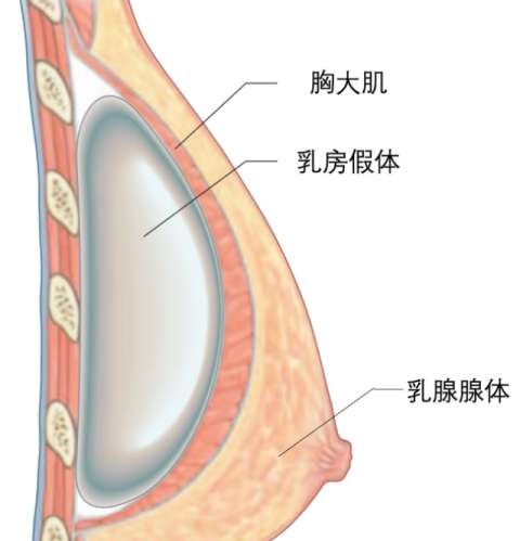 隆胸hh01.jpg 隆胸hh01.jpg