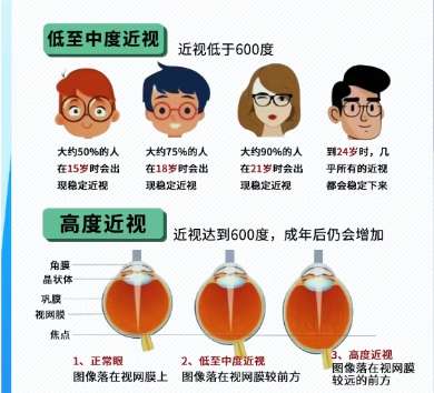 近视眼