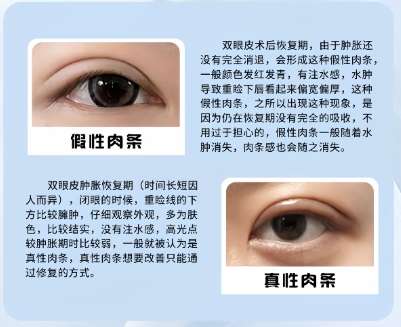 双眼皮