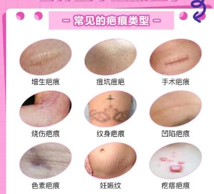 祛疤