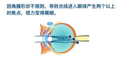散光矫正 散光矫正