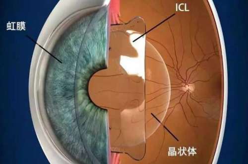 ICL晶体植入术 ICL晶体植入术