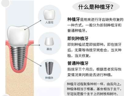牙齿种植 牙齿种植
