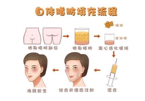 上海第二人民医院脂肪填充价格！单部位大概1万元左右起