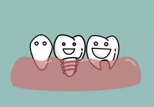 南方医科大学南方医院种牙多少钱？单颗费用1万元左右起