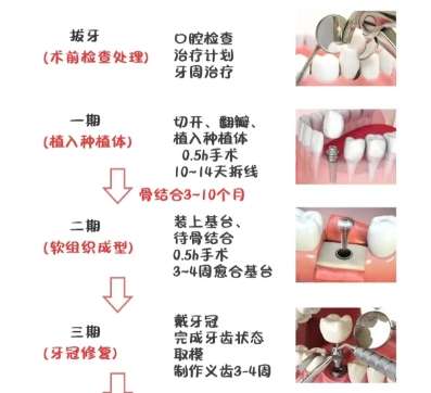 牙齿种植 牙齿种植