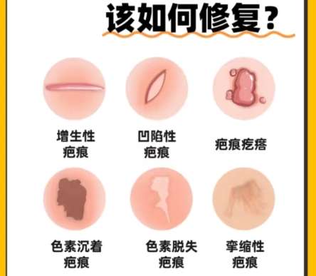 祛疤 祛疤