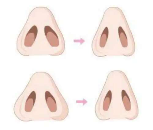 缩鼻翼dm1.jpg