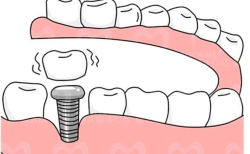 上海第二人民医院牙齿种植价格，单颗、多颗费用怎么算