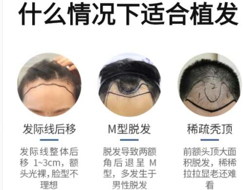 植发 植发