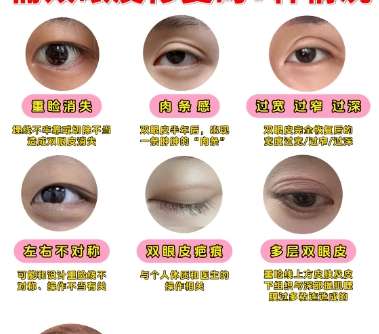 双眼皮