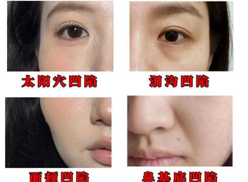 面部填充 面部填充