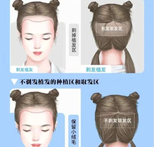植发