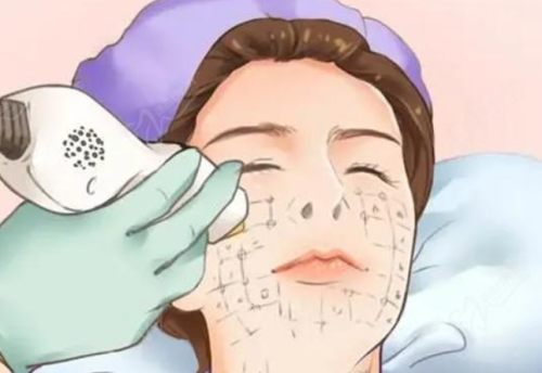 上海九院做热玛吉哪个医生做的好？手法专业不敷衍，这几位闭眼冲！