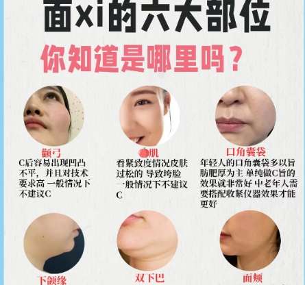 面部吸脂 面部吸脂