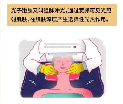 光子嫩肤