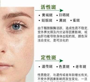 祛斑 祛斑