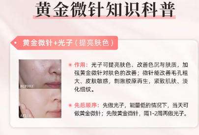 黄金微针 黄金微针