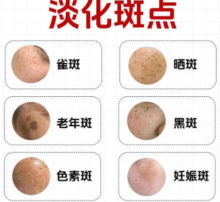 祛斑 祛斑