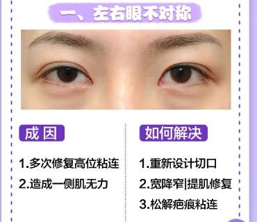 双眼皮修复