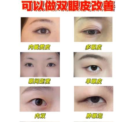 双眼皮 双眼皮