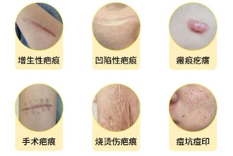 祛疤