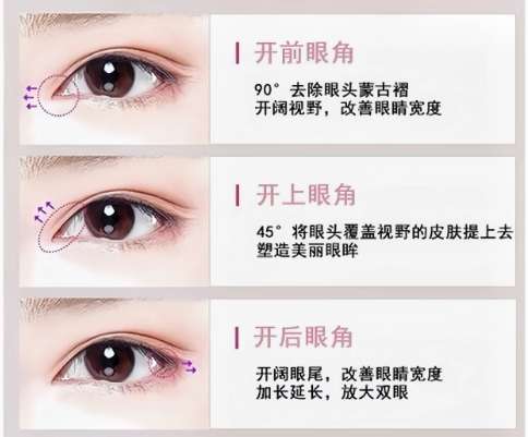开眼角 开眼角