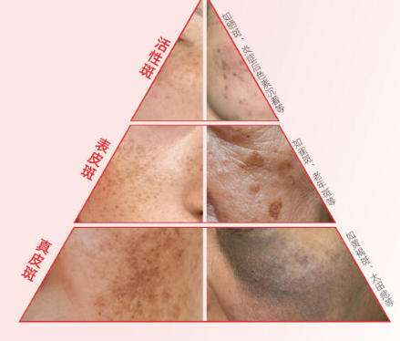 祛斑 祛斑