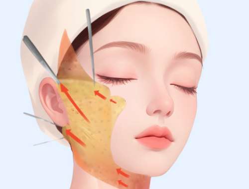 拉皮做大切口要多少钱？40+必看，无套路拆解真实报价