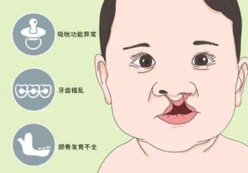 唇裂0.jpg