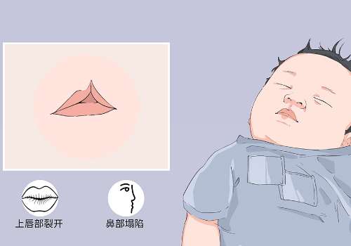 唇裂.jpg