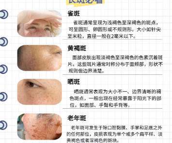 祛斑