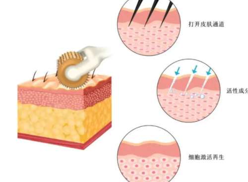 黄金微针dm 黄金微针dm